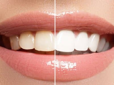 Clareamento dental em Peruíbe — Dra. Camila Meister