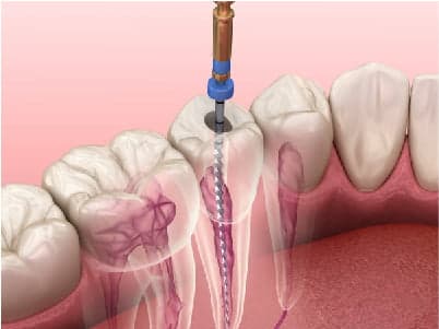 Endodontia (canal) em Peruíbe — Dra. Camila Meister