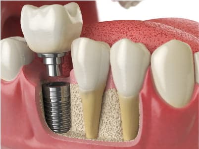 Implante dentário em Peruíbe — Dra. Camila Meister